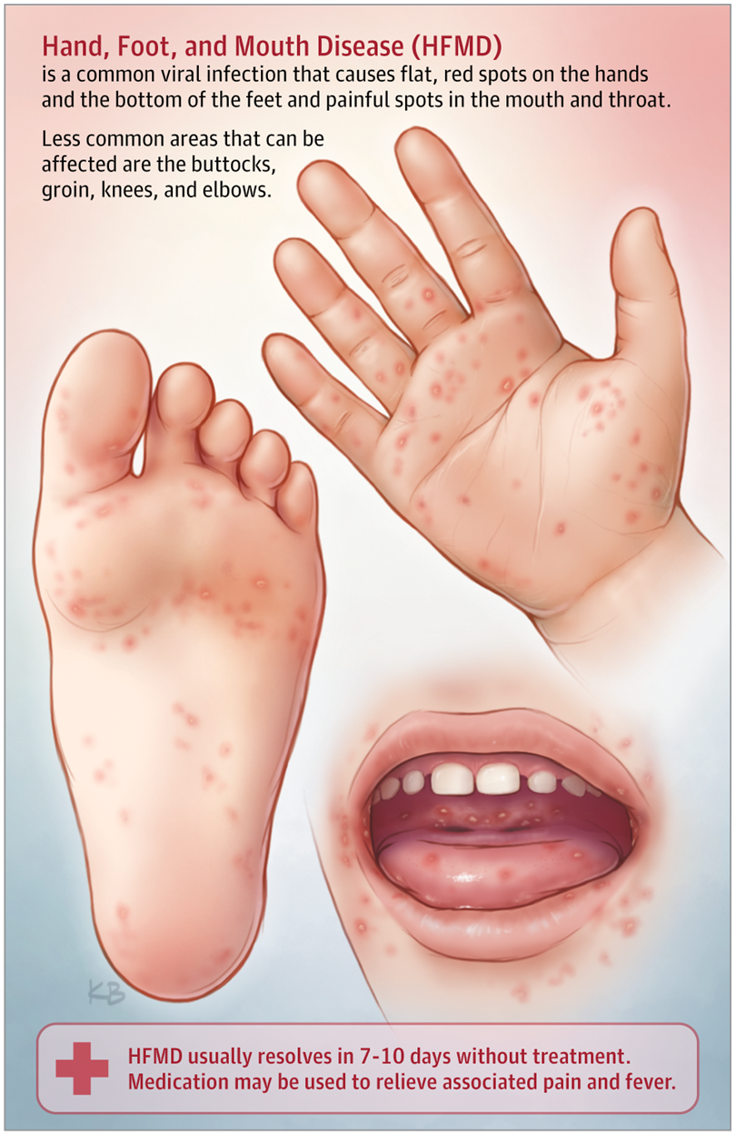 WHAT IS HAND, FOOT AND MOUTH DISEASE?